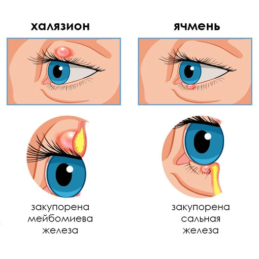 халязион и ячмень